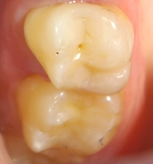 Кариес — лечение и профилактика кариеса в стоматологическом